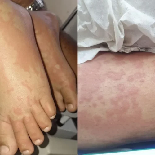 Criança é internada por suspeita de contaminação após uso de detergente Ypê