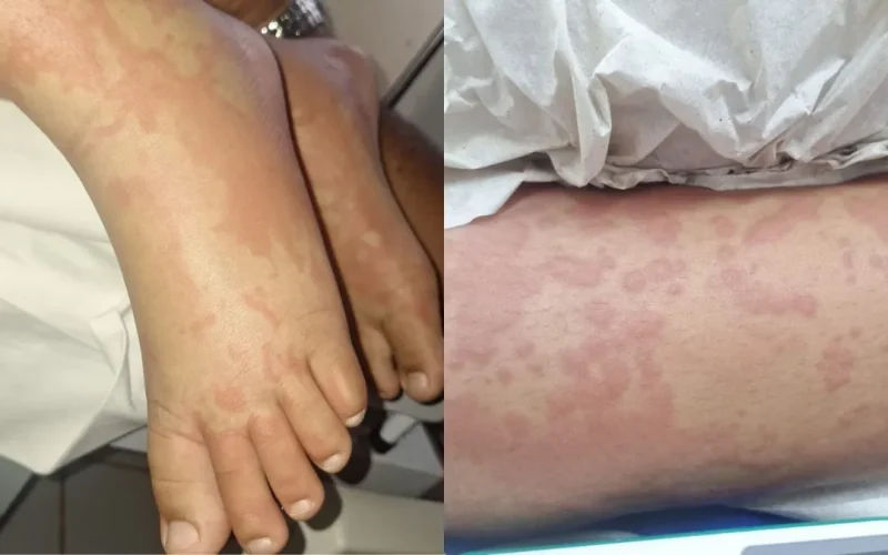 Criança é internada por suspeita de contaminação após uso de detergente Ypê