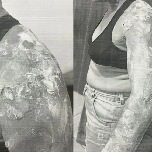 Homem joga panela de feijão quente na esposa e é preso por violência doméstica no Sertão da Paraíba