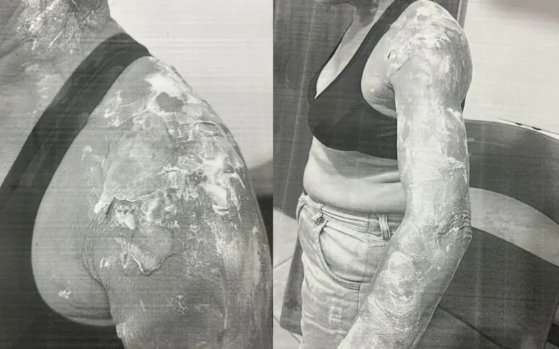 Homem joga panela de feijão quente na esposa e é preso por violência doméstica no Sertão da Paraíba